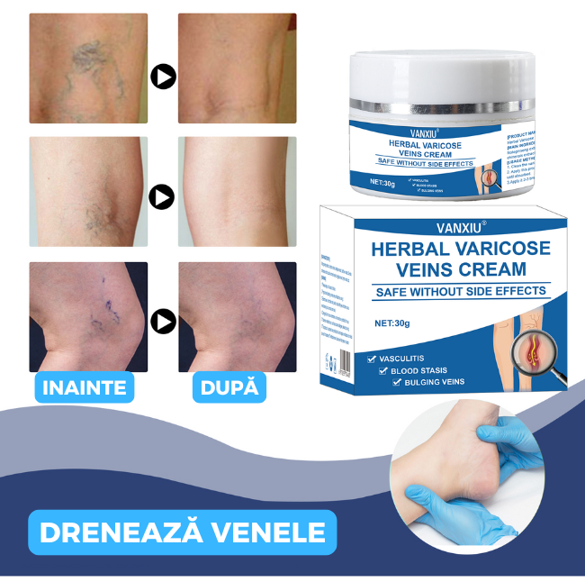 Cremă naturală împotriva varicelor și vergeturilor