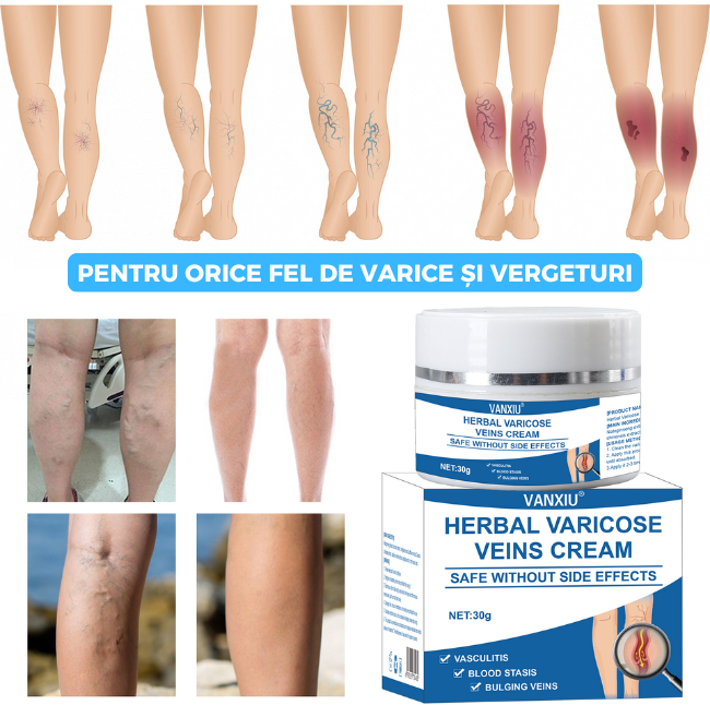 Cremă naturală împotriva varicelor și vergeturilor